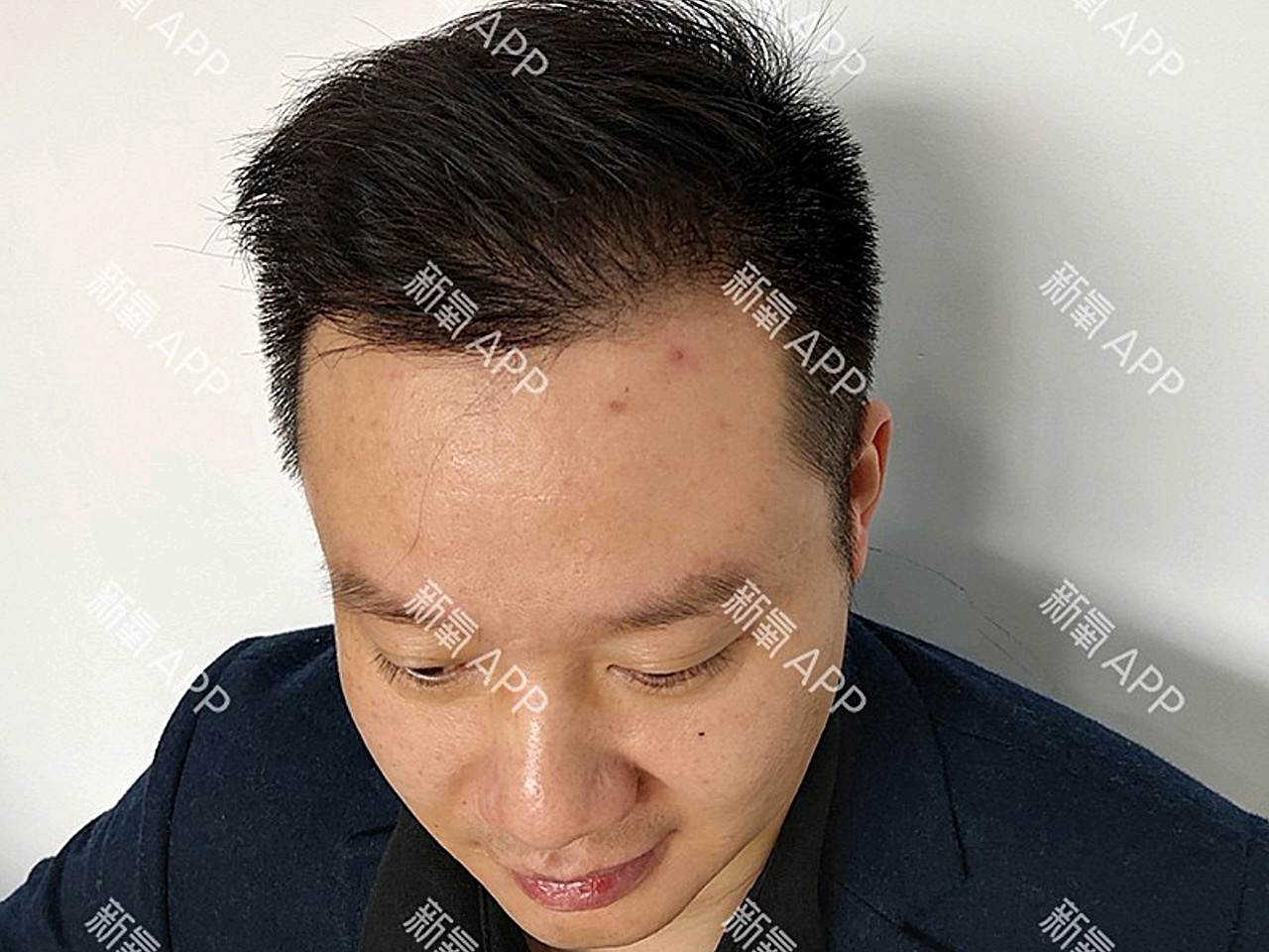 【头顶加密种植】头发稀疏加密种植 2000单位毛发种植 签约植发 存活