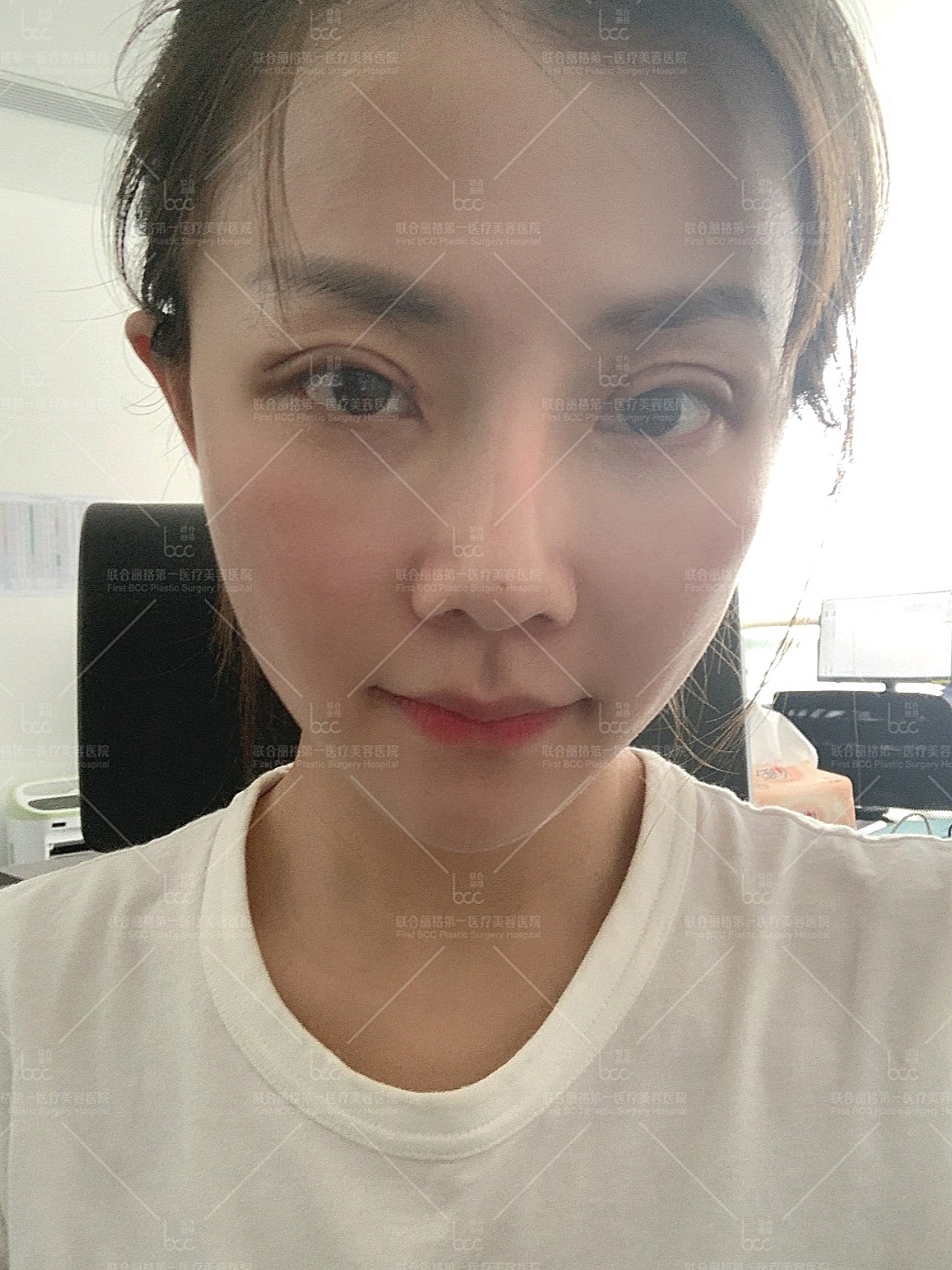 我做了双眼皮失败修复 单侧肌力调整 眼尾提升.