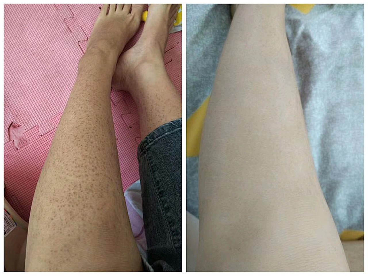 鸡皮肤,学名叫毛周角化症."鸡皮肤"是毛囊周围的角_圈子-新氧美容整形