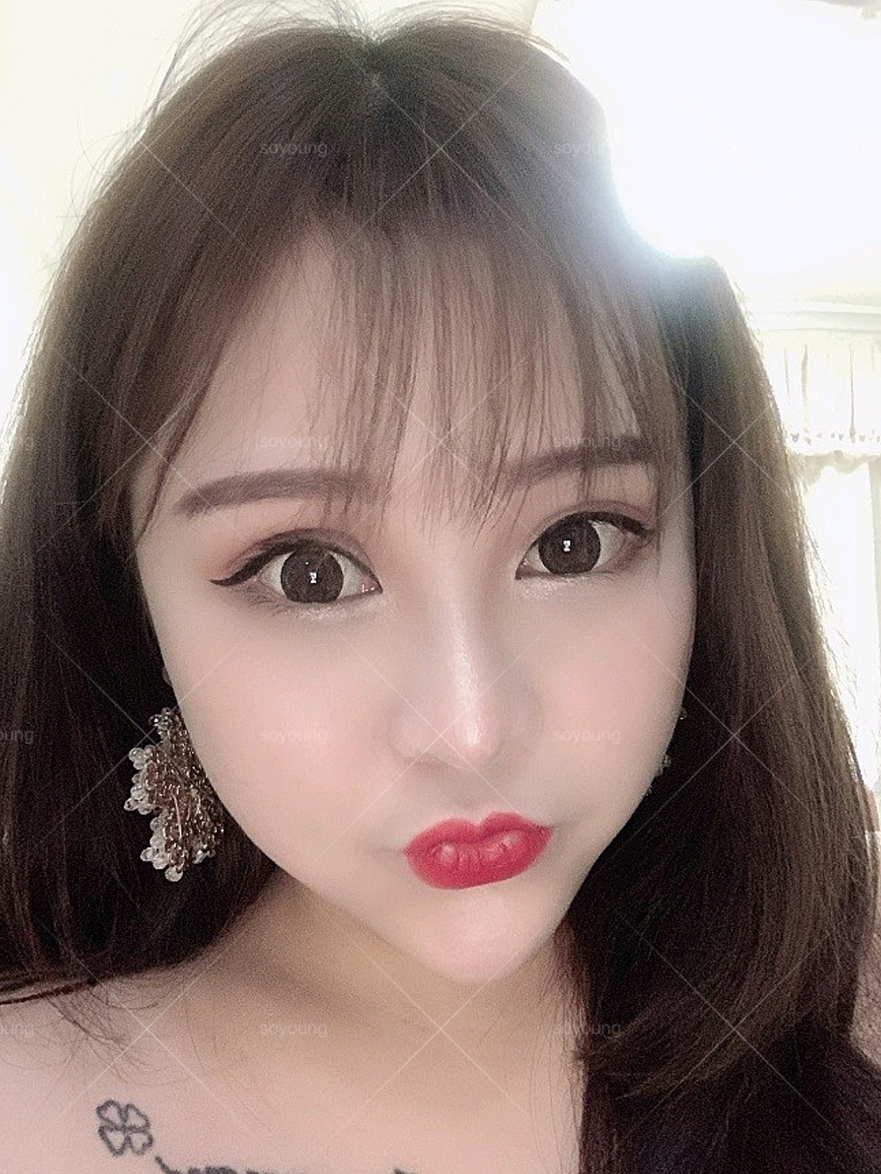 双眼皮161天,感觉眼窝没有那么深了,眼睛98也大了_圈子-新氧美容