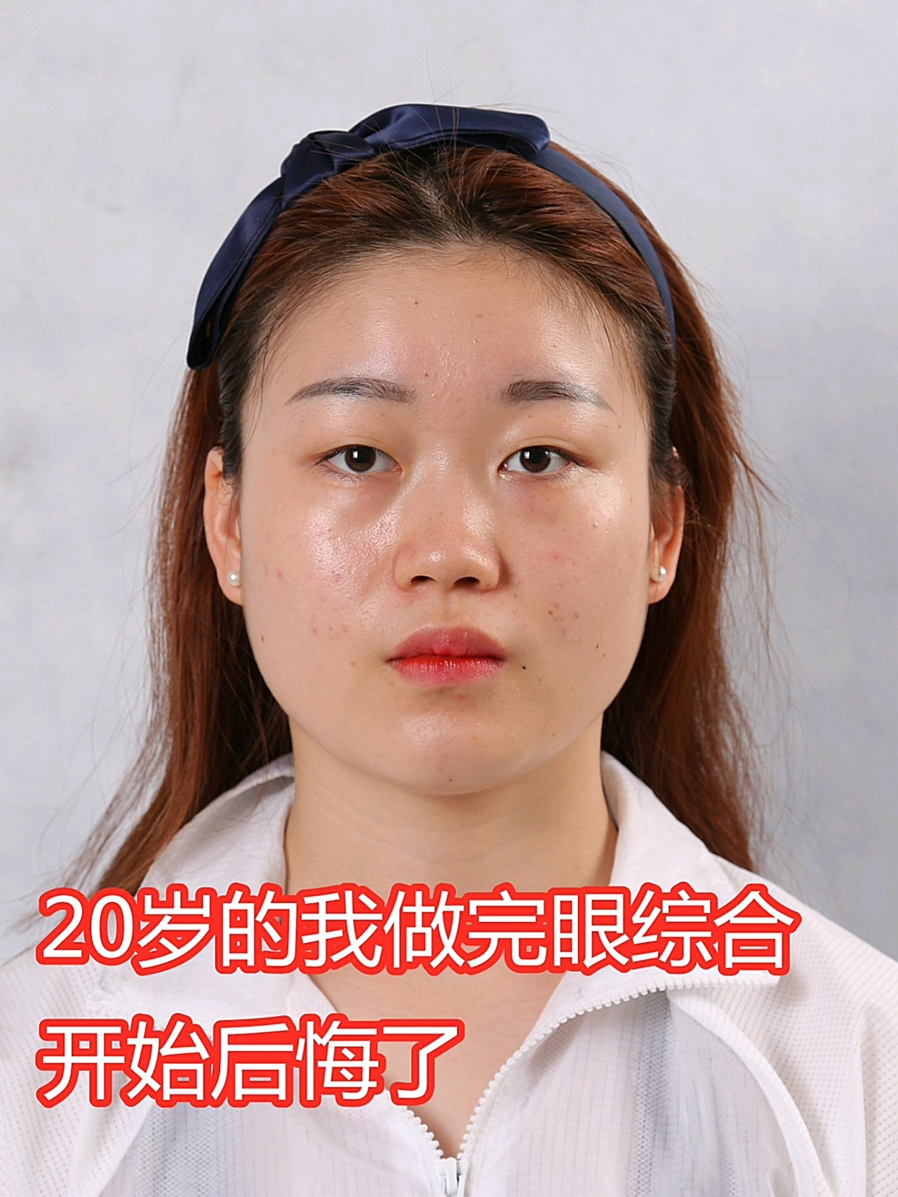 7777术前单眼皮眉眼间距较远眼部脂肪比较多