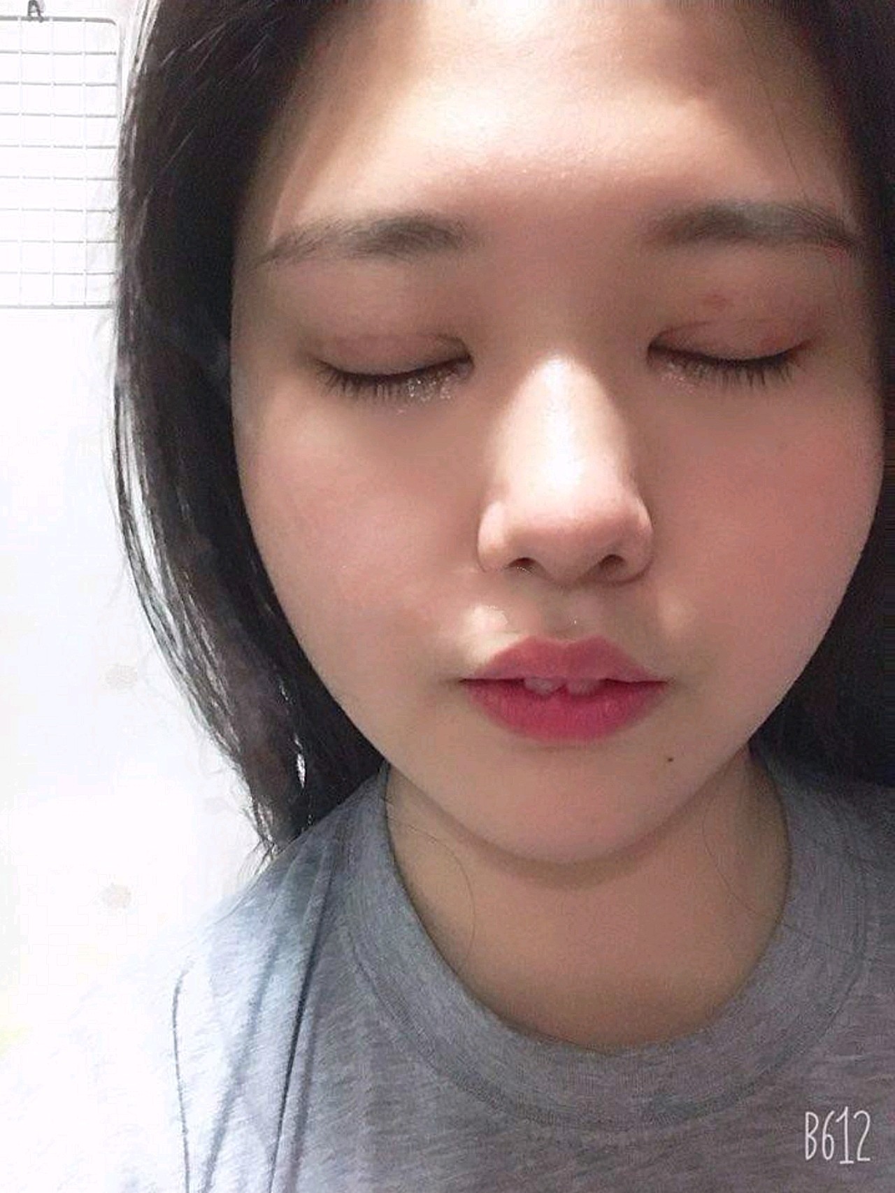 双眼皮手术15天,拆完线后眼睛恢复很快呢,现在已经_圈子-新氧美容整形
