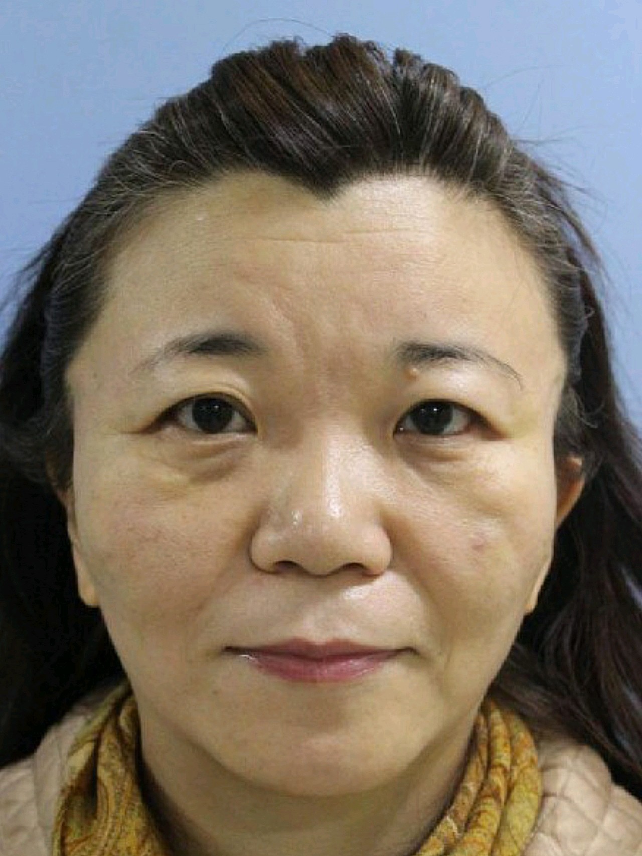 【术前诊断】:中下面部下垂 法令纹明显【方案设计】_圈子-新氧美容