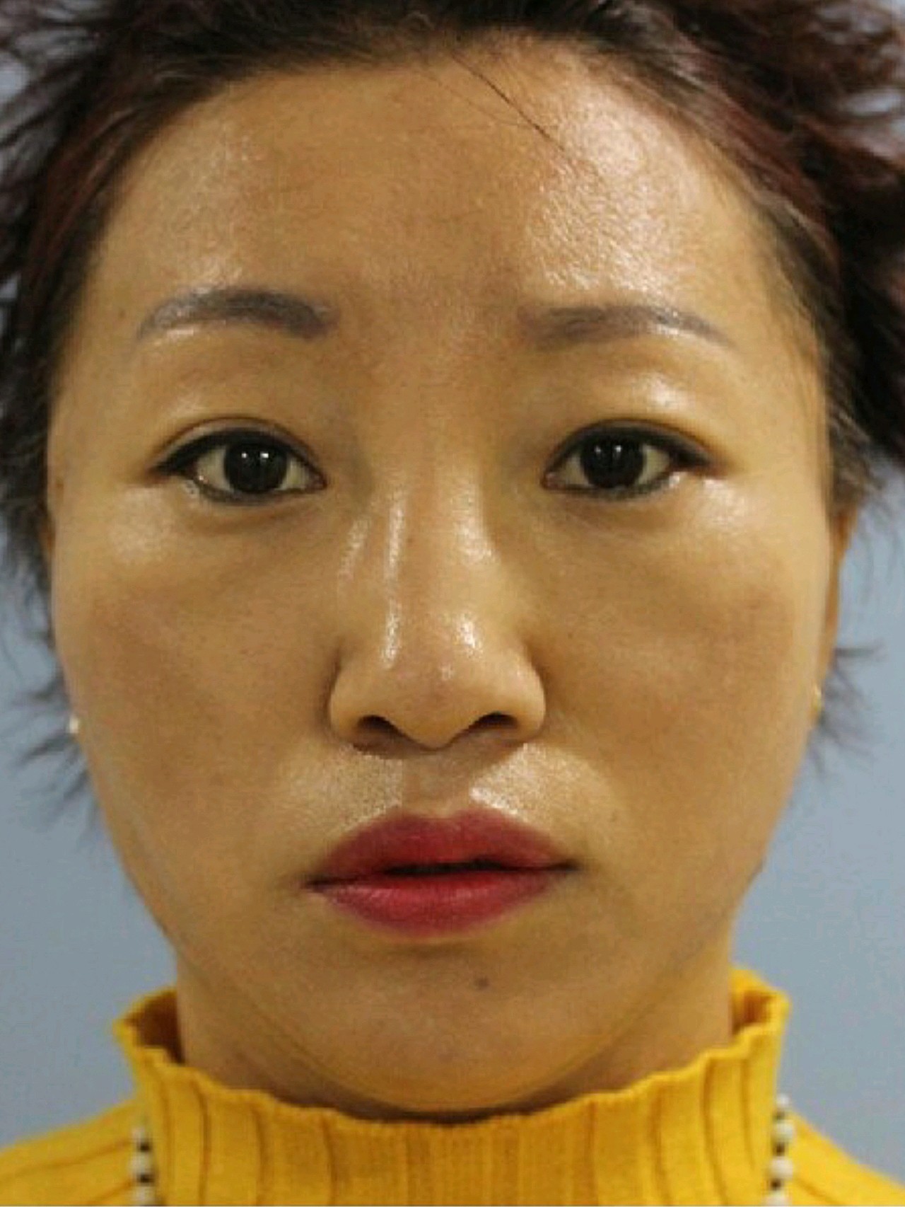 【术前诊断】:中下面部松弛 上眼睑下垂【方案设计】_圈子-新氧美容