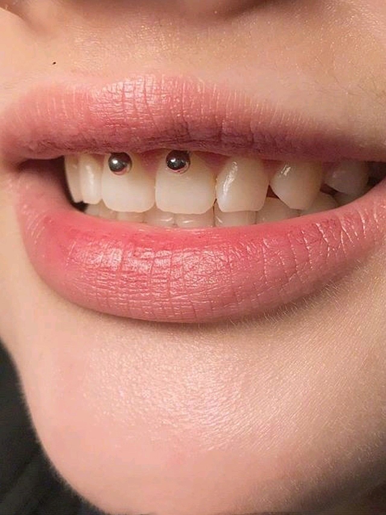 穿刺新潮流——牙龈钉,打在唇系带上,微笑时才看得到_圈子-新氧美容