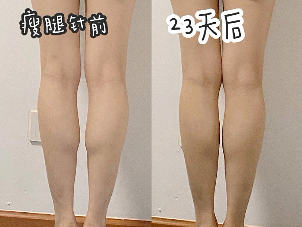 瘦腿针打完23天前后对比,虽然腿围双腿只减了一厘米