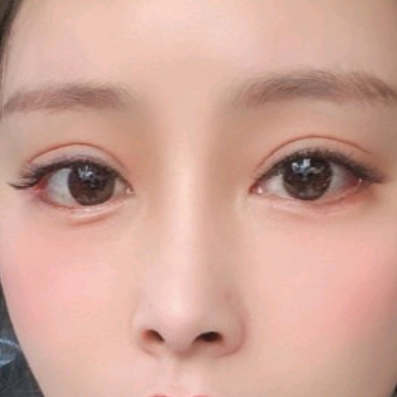 有一双大眼睛,却徒有其表,是个内双,真的挺让人头疼_圈子-新氧美容