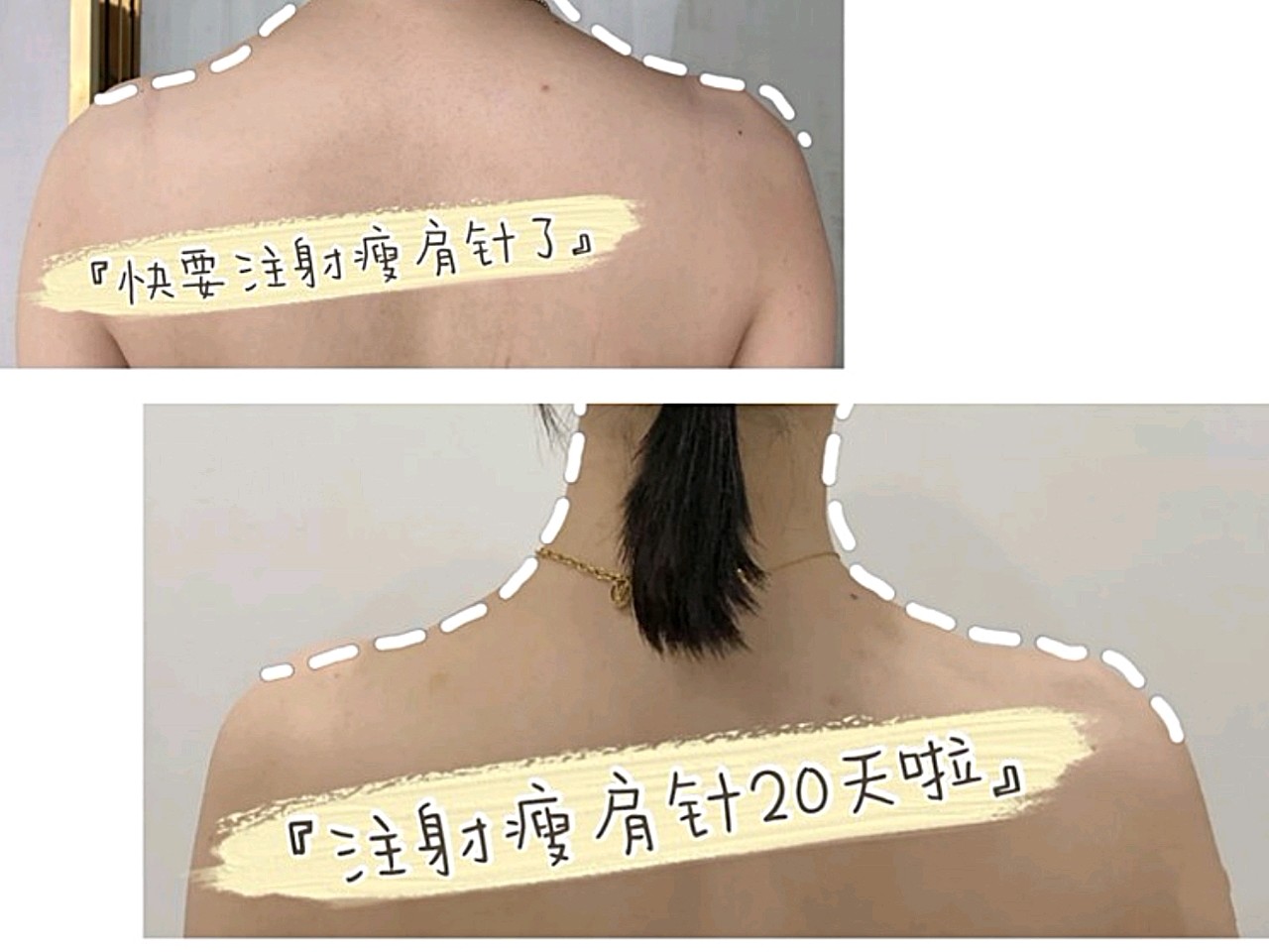 瘦肩针位置图图片