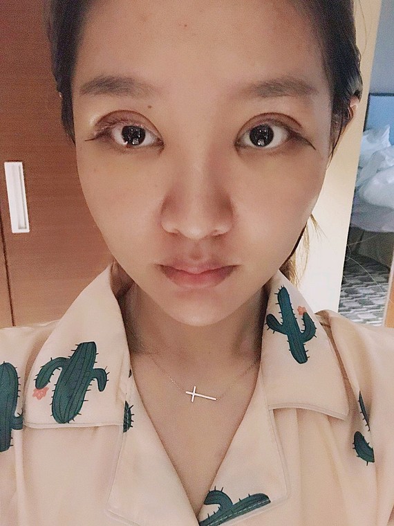 【义乌欧莱美】韩式微创双眼皮综合术后第1天