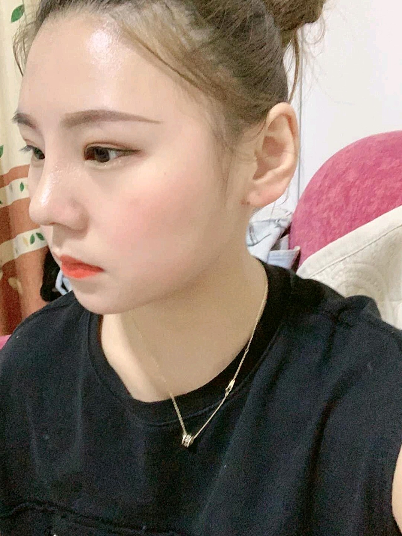 【茗汇整形-肋软骨隆鼻术后第7天】