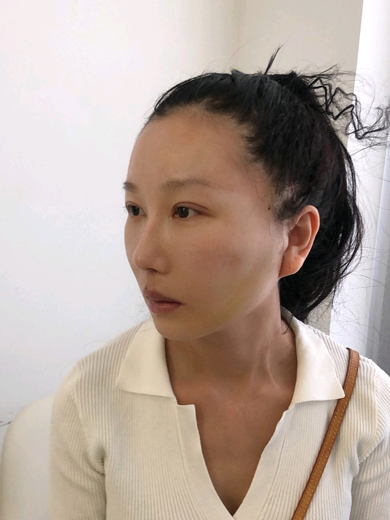 "小切口"拉皮 人中缩短=术后1周