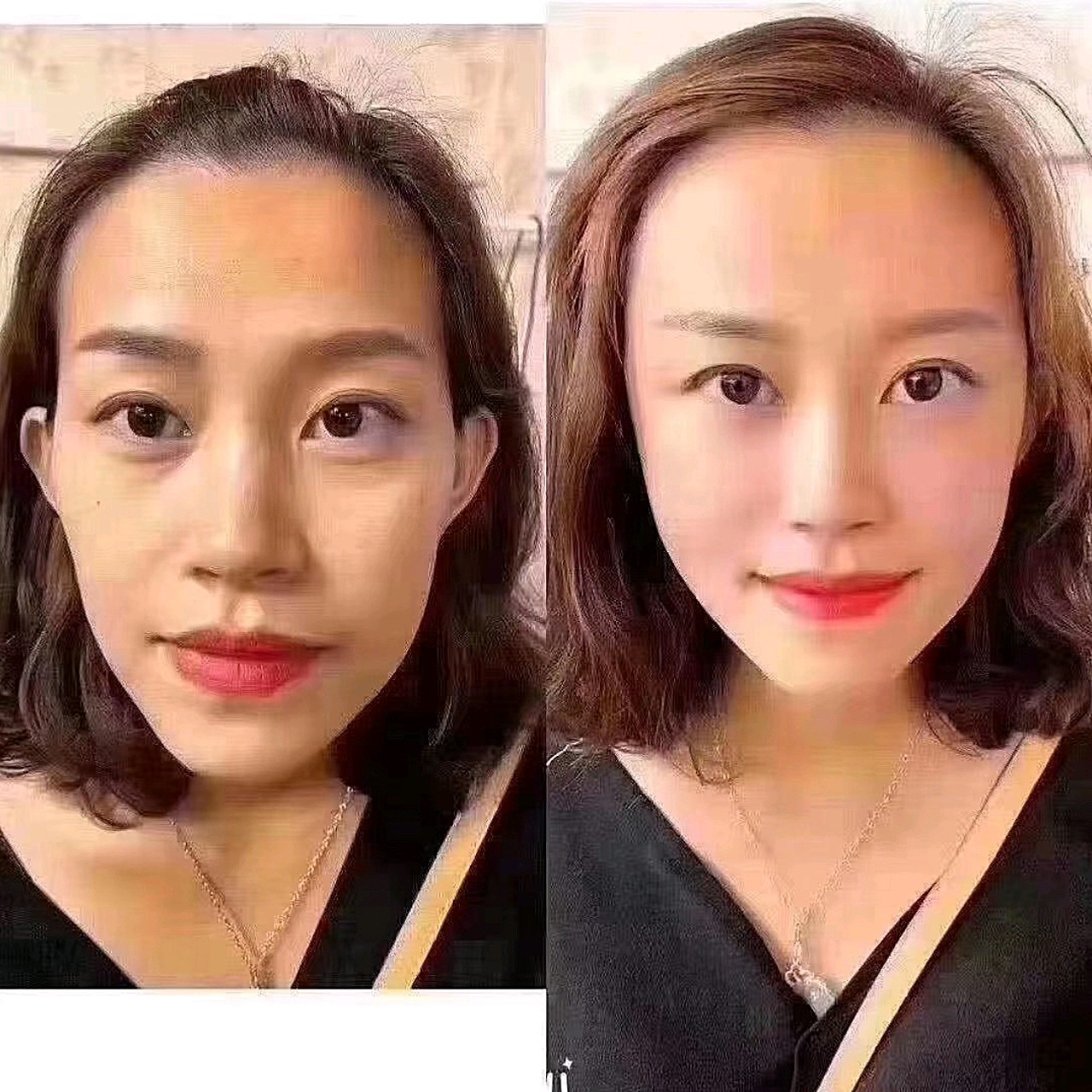 眼袋泪沟凹陷,太阳穴凹陷,脸颊凹陷,总_圈子-新氧美容整形