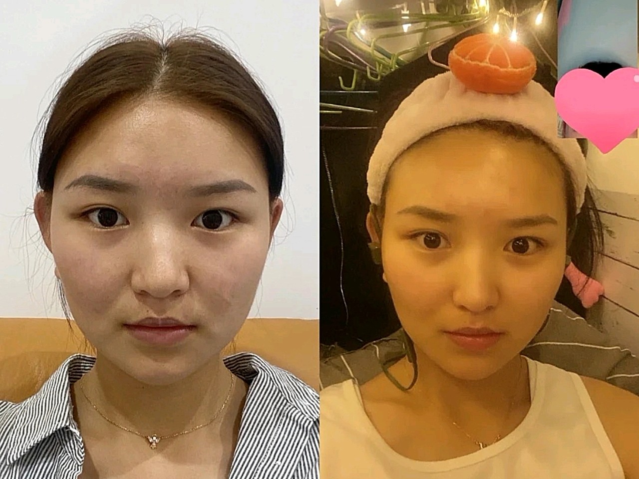 沈阳汇美人瘦脸针