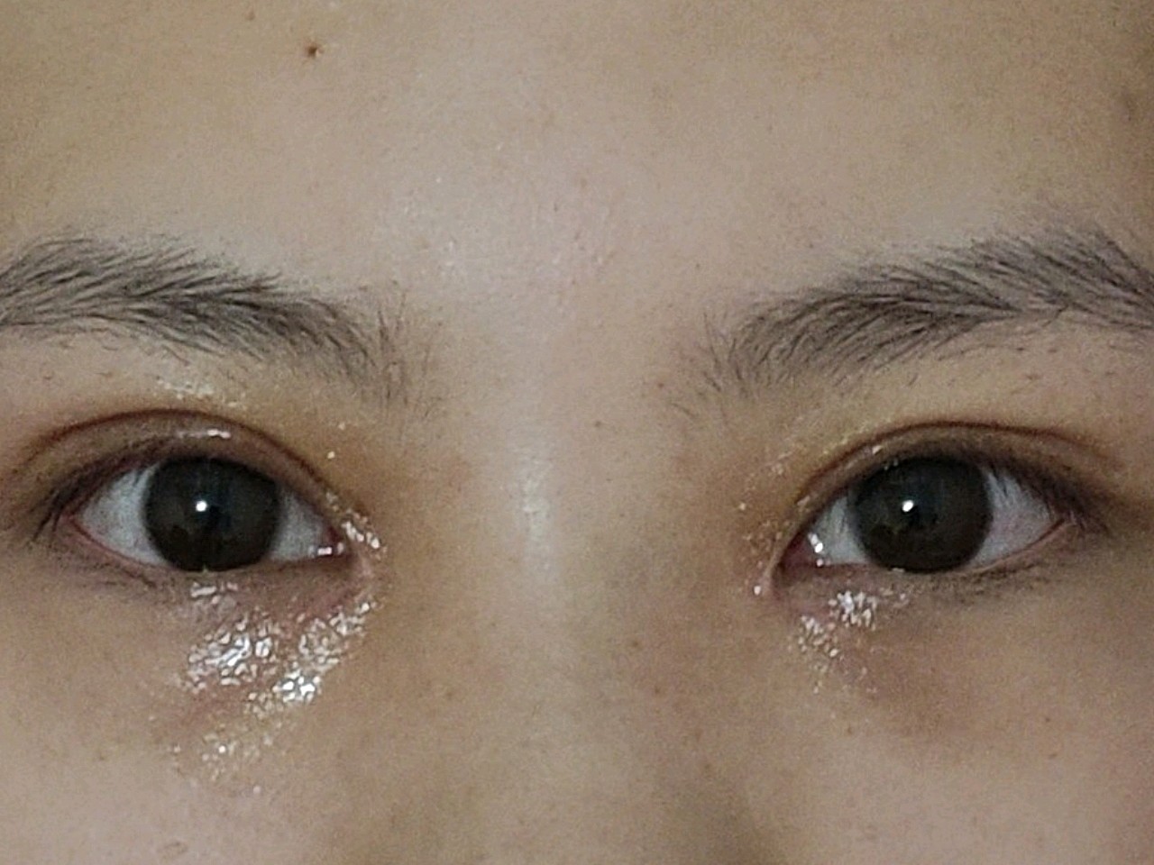 三个多月了……极度不对称开眼角还2500 也是不对_圈子-新氧美容整形