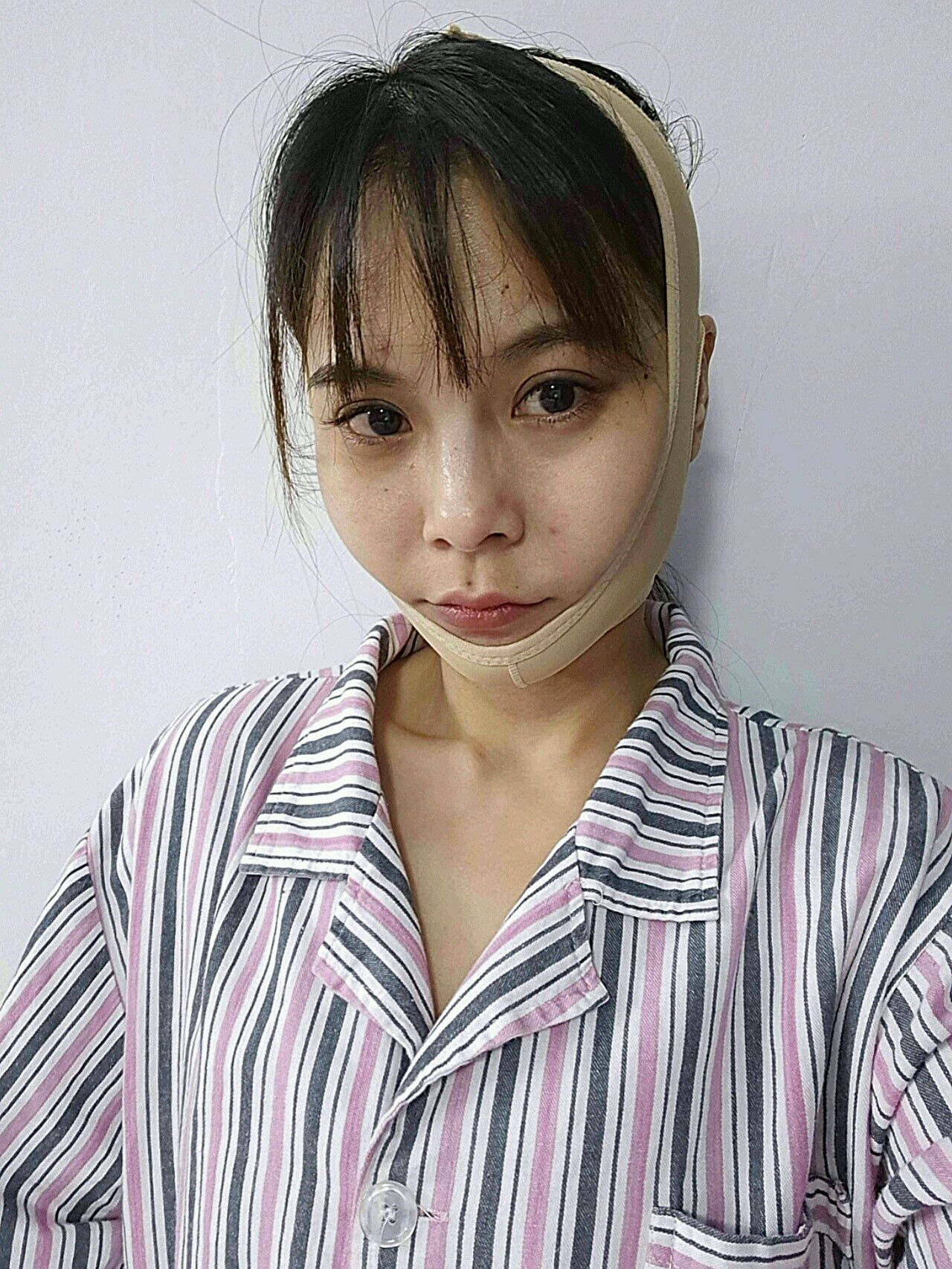 【颌面手术第2天】