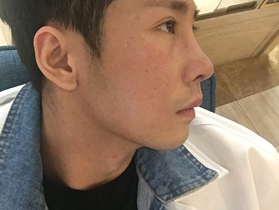 拆线啦,歪鼻,朝天鼻的问题解决了,鼻梁挺直,侧面看_圈子-新氧美容整形