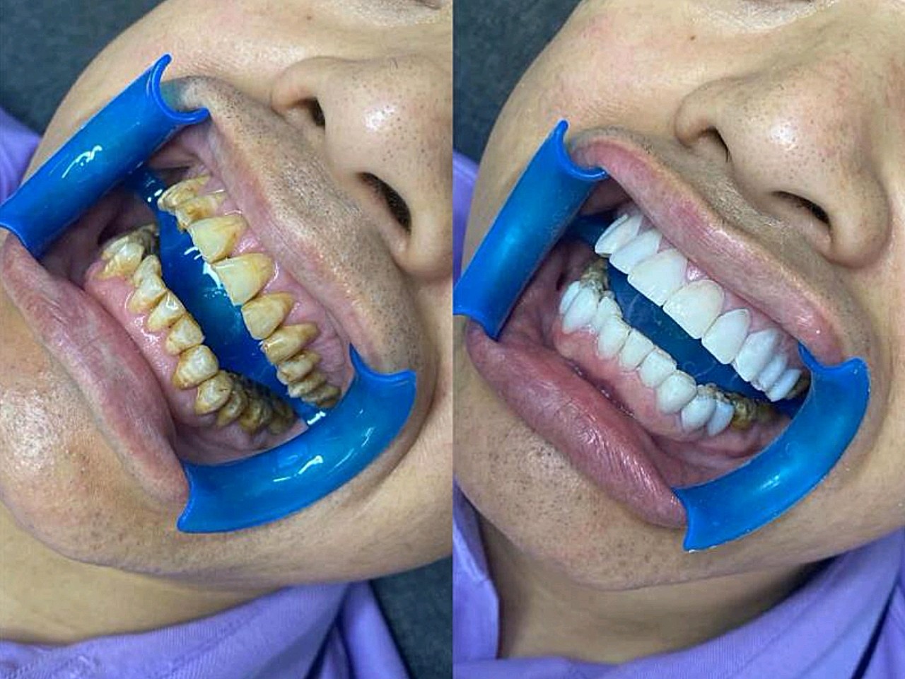 提前咬出牙模,然后根据_圈子-新氧美容整形