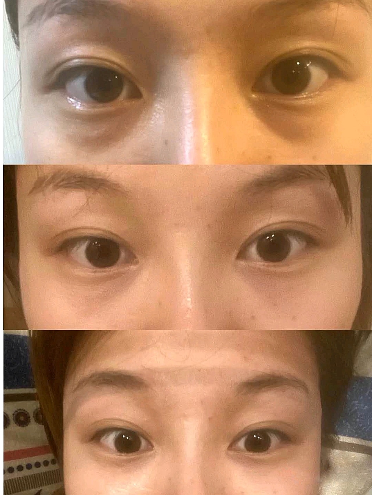 我的眼袋和我的黑眼圈长年累积,特别是这两年带娃更加变得又黑