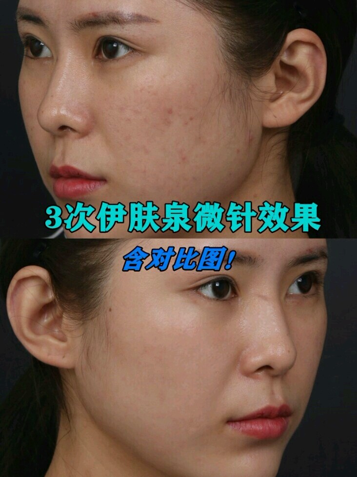 3次伊肤泉微针效果含对比图