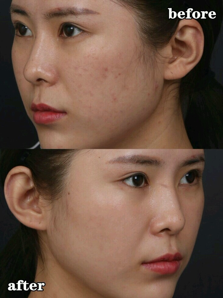3次伊肤泉微针效果,含对比图