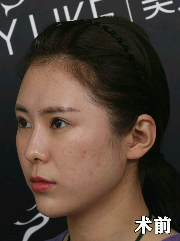 3次伊肤泉微针效果含对比图