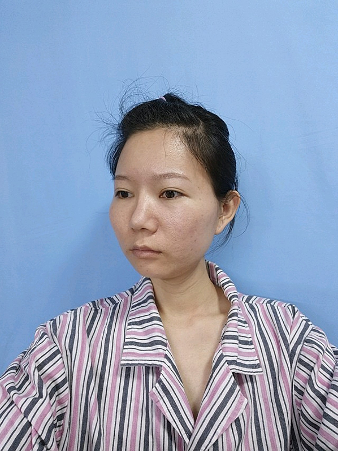 饱满的脸型,立体的下颌缘一直都是年轻的标志,而我却_圈子-新氧美容