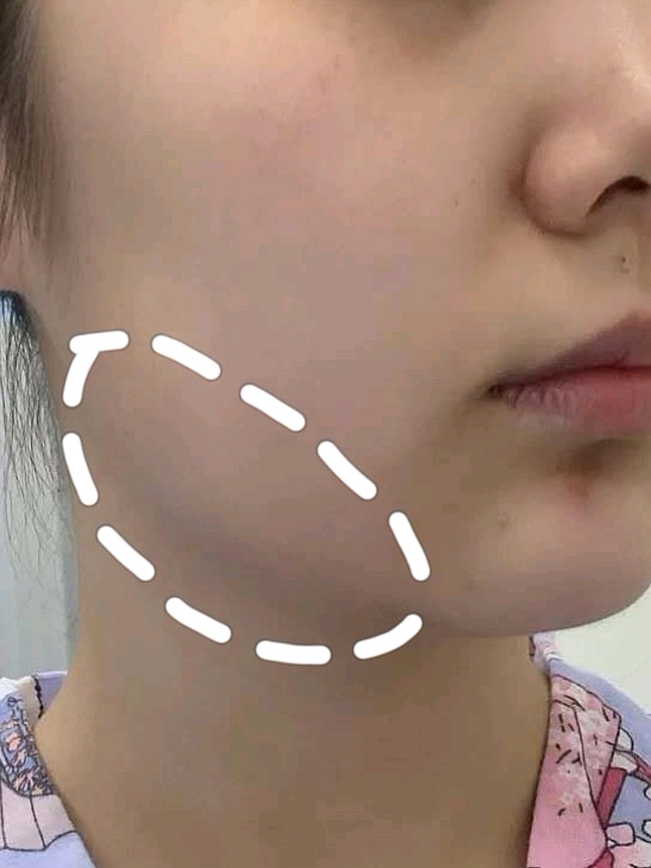 我做了注射保妥适,来提升自己的下颌缘,效果还是有的_圈子-新氧美容