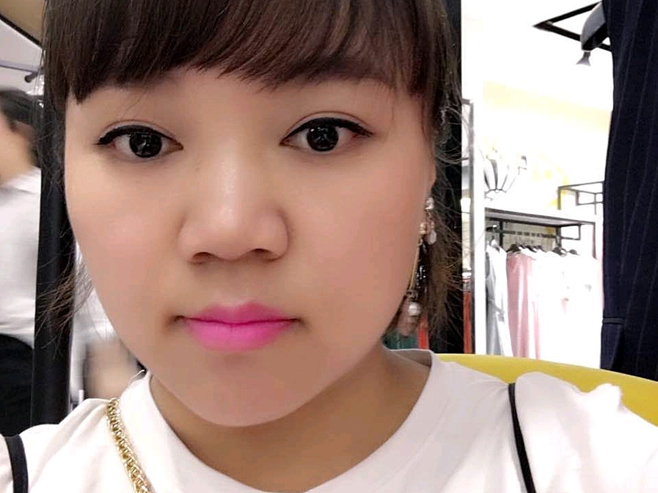 这是第二次做了,脸上本来肉就多的要命,之前吸了一点_圈子-新氧美容