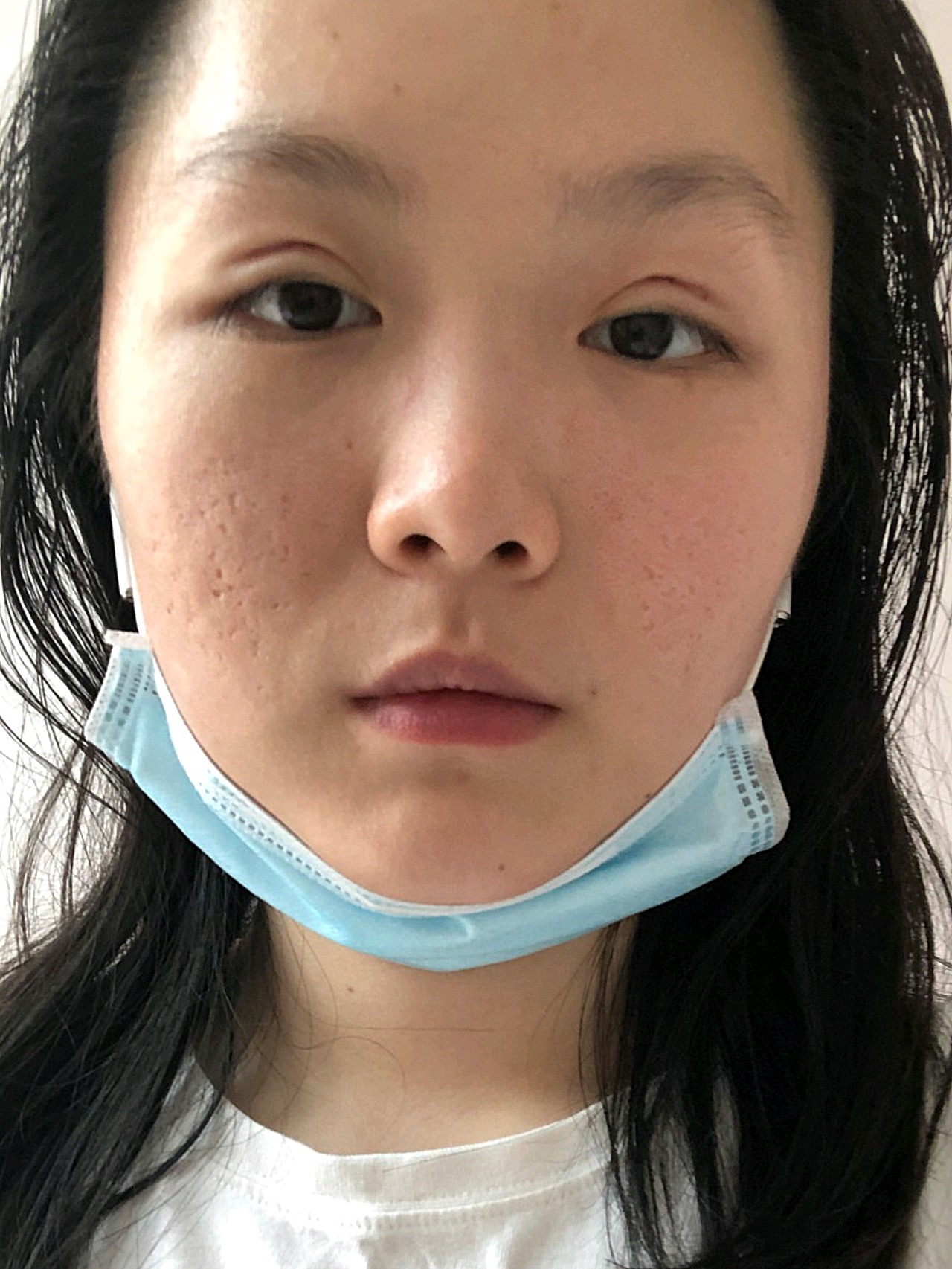 小切口双眼皮的术后第一天,感觉比全切的肿胀轻一些.