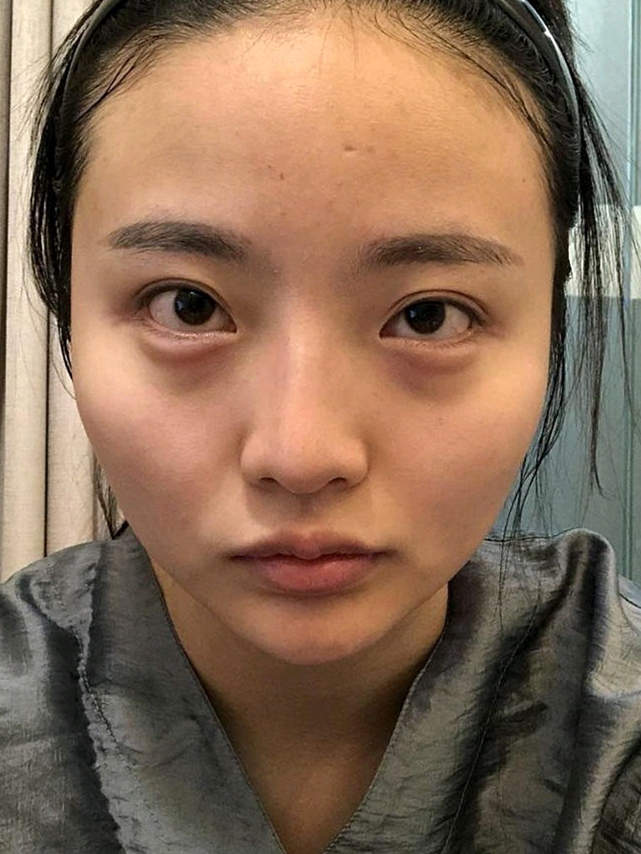 嘟嘟肉说好听点是可爱,说不好听点就是一脸横肉,丛侧_圈子-新氧美容