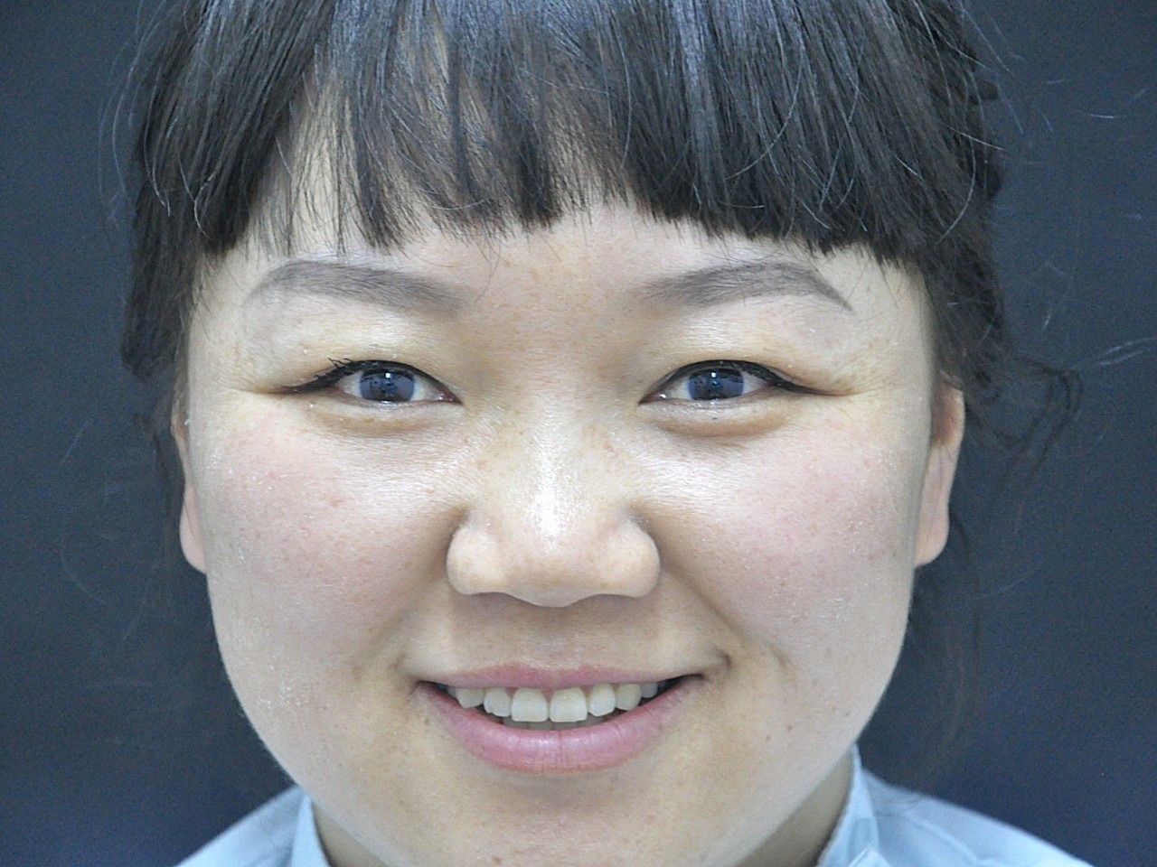 这是第二次做了,脸上本来肉就多的要命,之前吸了一点_圈子-新氧美容