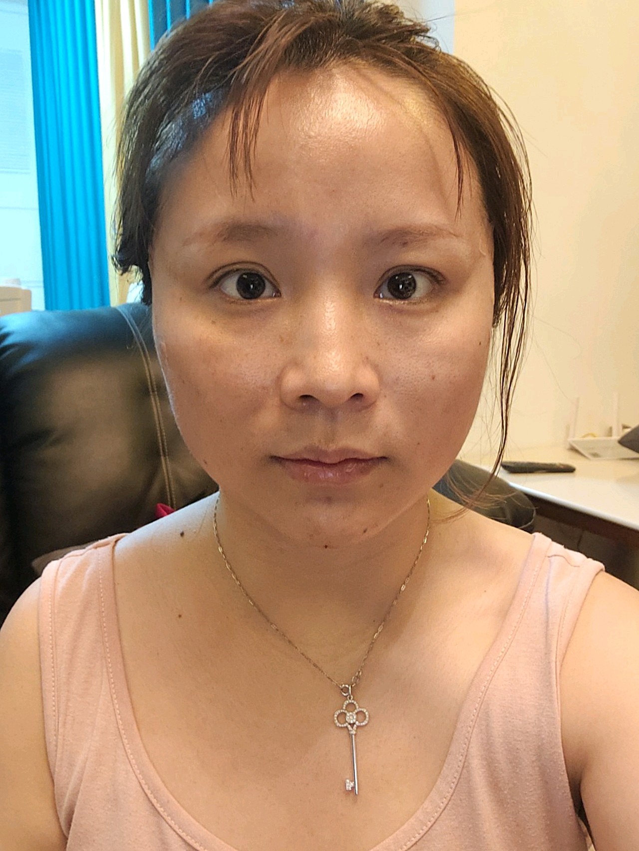 恢复状况:做完线雕提升已经10天了,疼痛几乎消失,_圈子-新氧美容整形