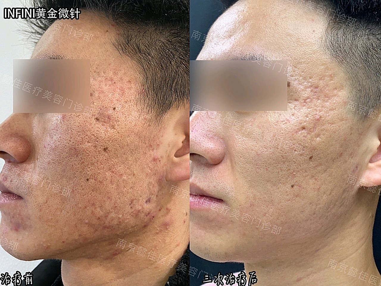 infini黄金微针治疗痤疮肌案例分享