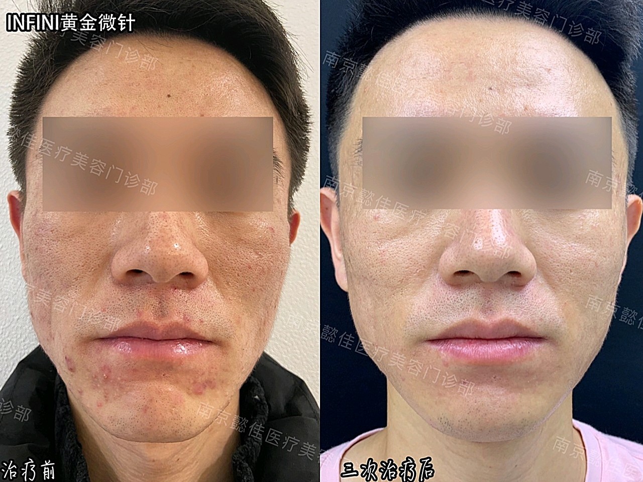 微针能治疗鸡皮肤吗(什么皮肤不可以做微针治疗)