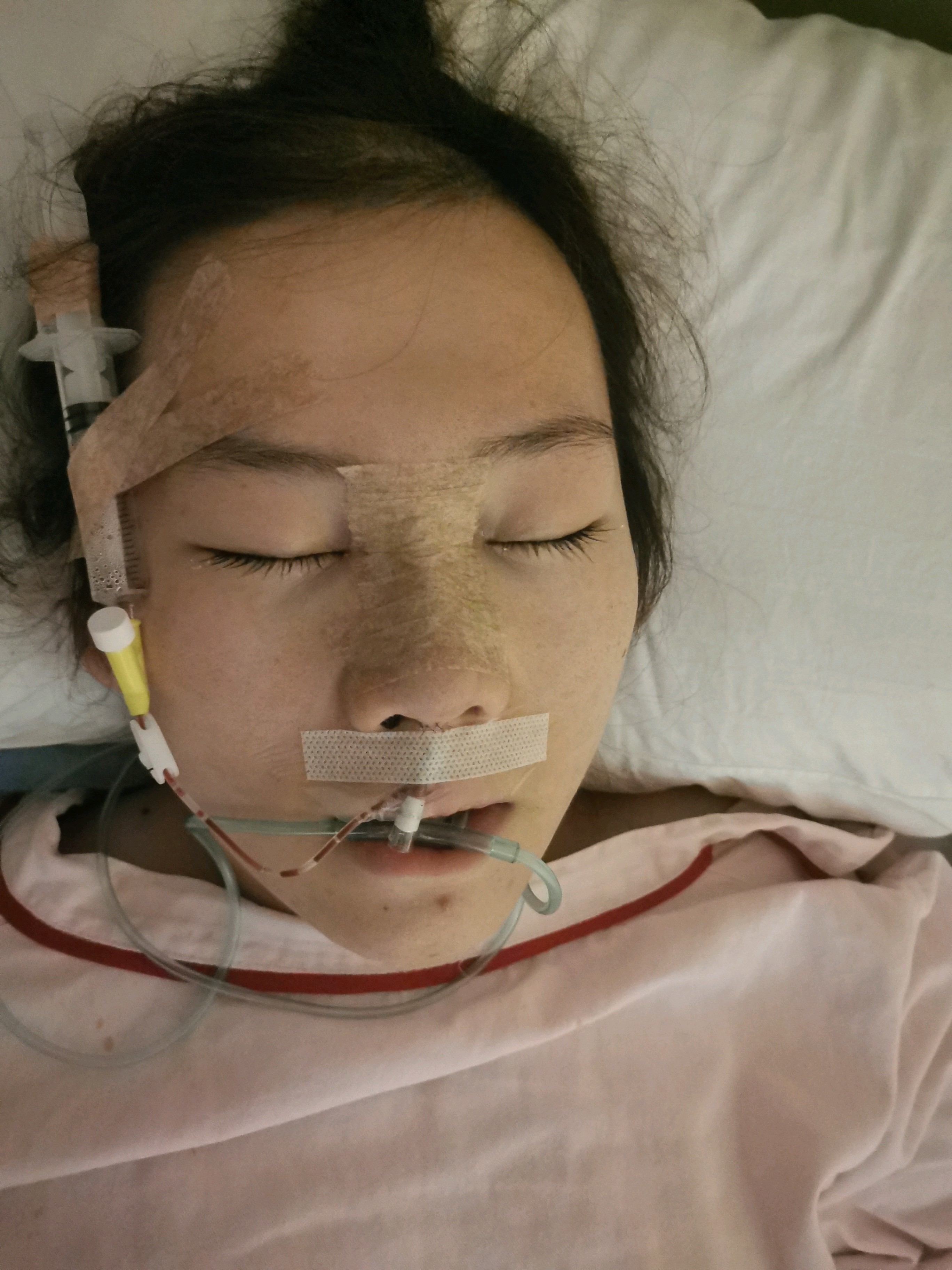 上午10点的手术,全麻苏醒过来用嘴巴吸着氧气,鼻子被