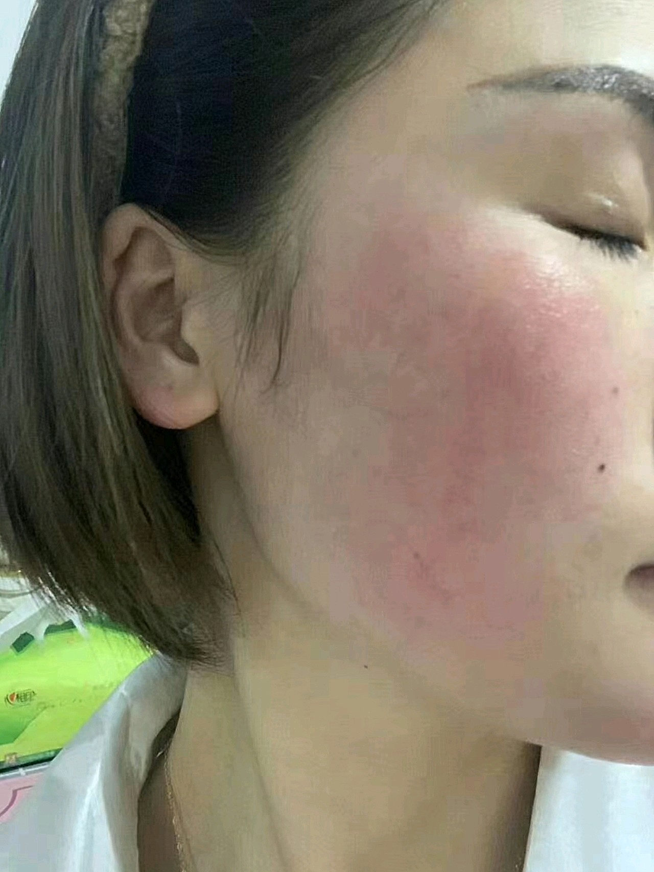 脸过敏去红血丝怎么办?敏感肌自救过程!