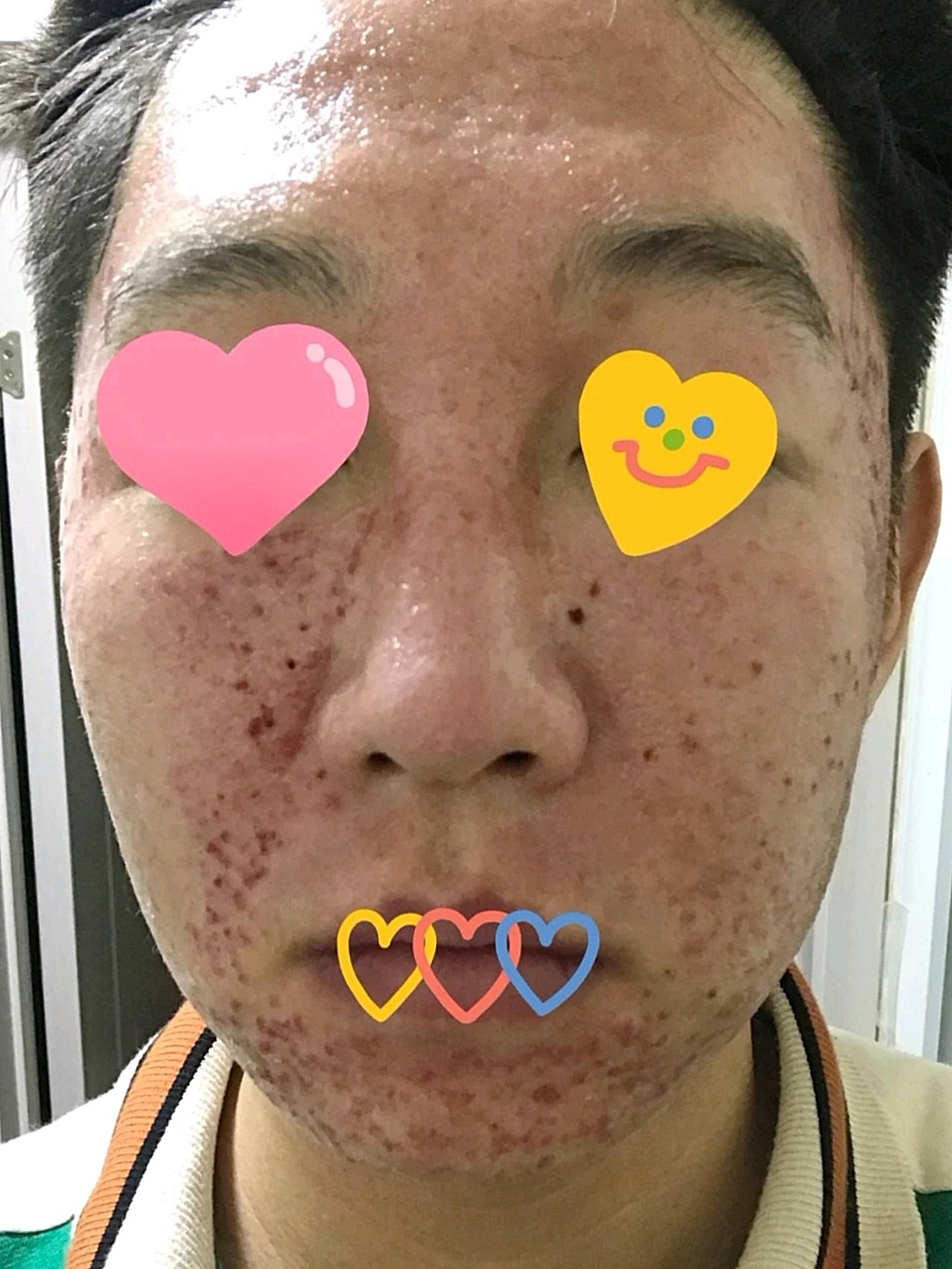 高中长青春痘我就把脸抠得坑坑洼洼的,近看还以为是月_圈子-新氧美容