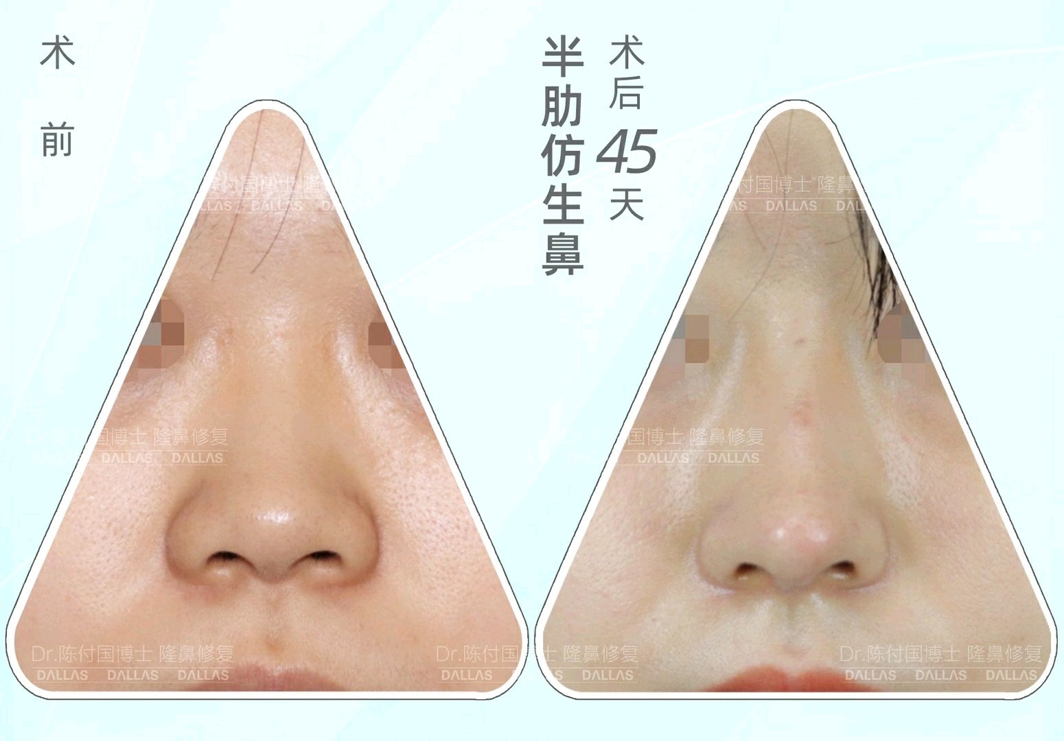 术前典型的鞍鼻&短鼻,侧面山根非常凹陷,凸嘴,鼻头