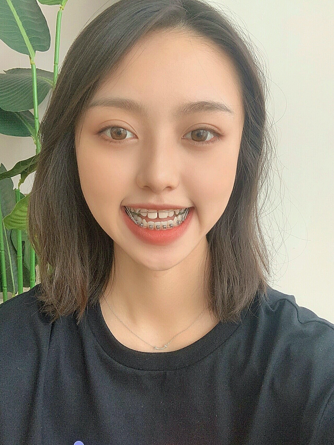 依然戴扩弓器,我本来下牙就比较整齐.