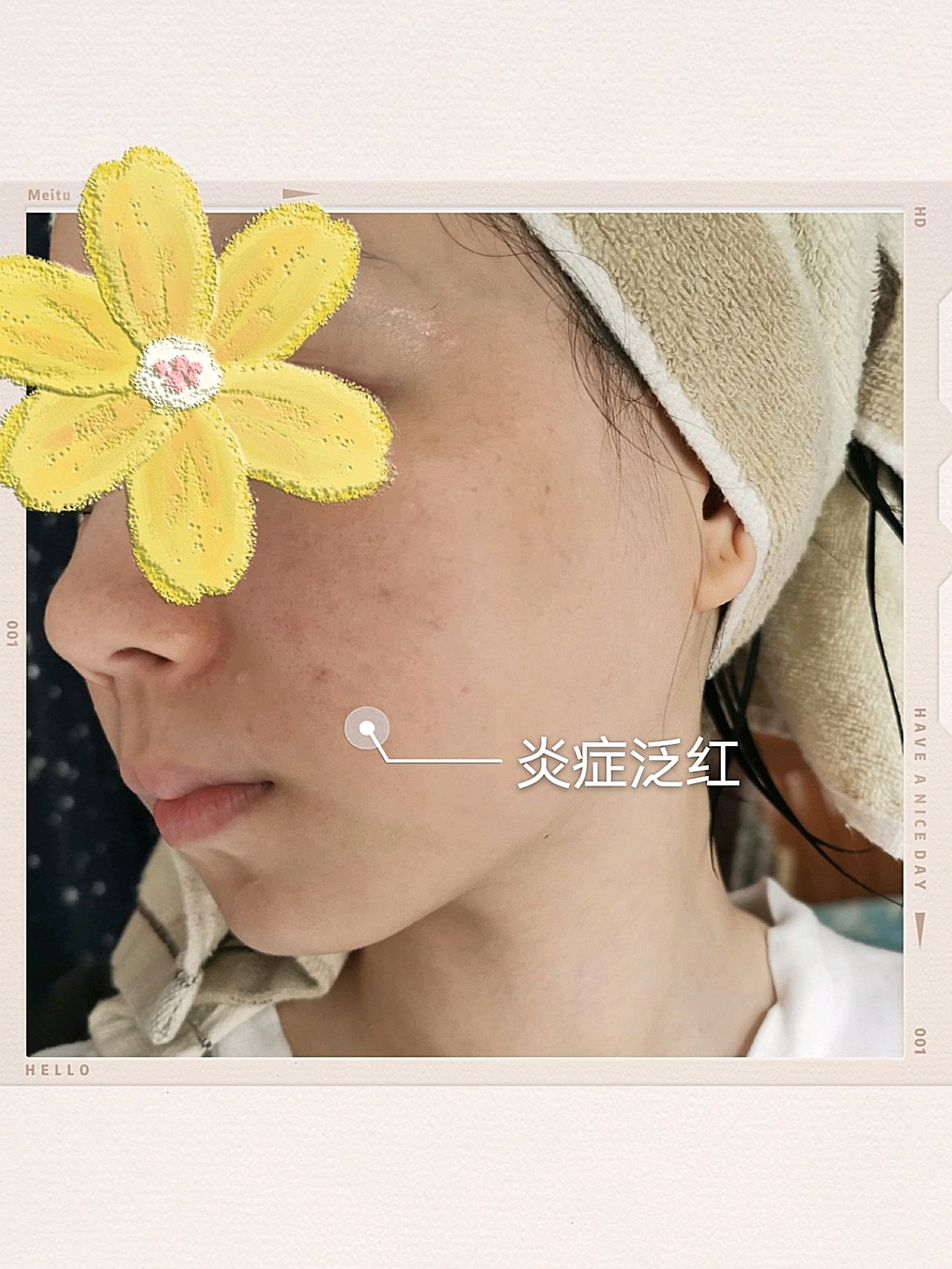 新氧体验官美即121面膜一贴修复我的泛红肌肤!