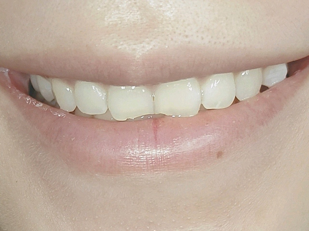 新氧体验官现在第五天啦,记录一下牙齿情况,变得更_圈子-新氧美容
