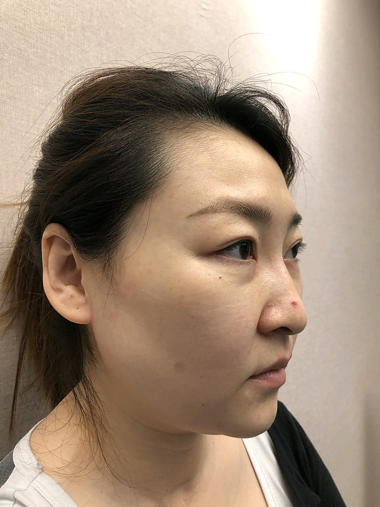 【取颊脂垫术后三天】术后第三天,今天看起来是不肿,_圈子-新氧美容