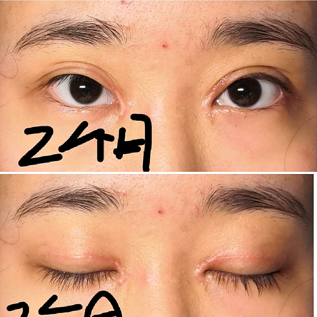 效果情况:全切双眼皮,已经两个月多一两天了,左眼还_圈子-新氧美容