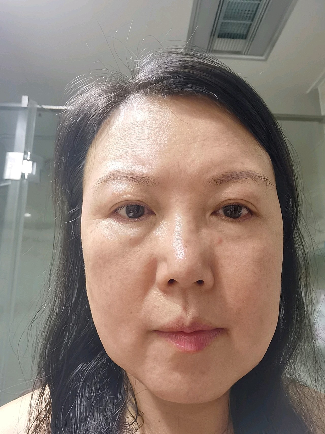 两个多月前买了2个,做了脸和脖子.前3张是今天拍的_圈子-新氧美容整形