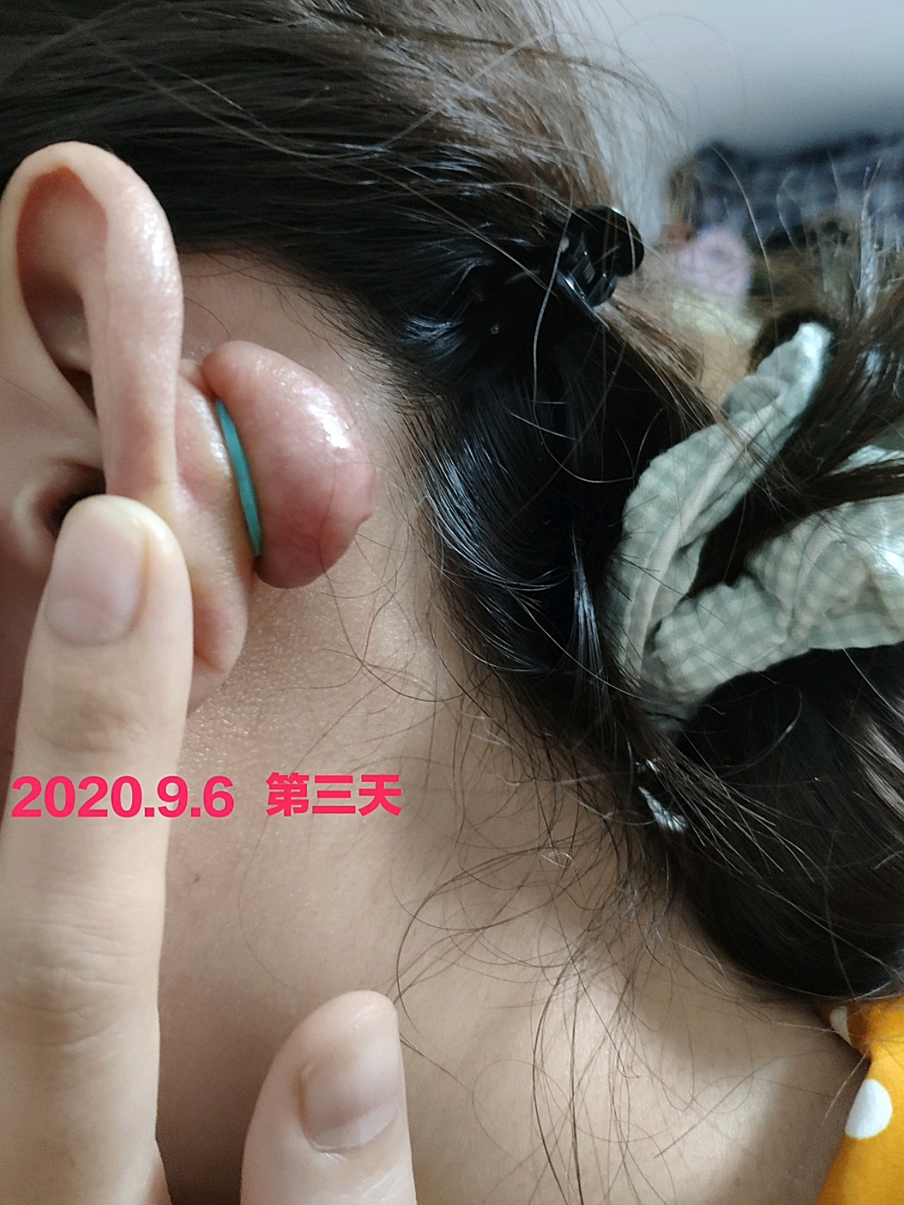 踩坑了,很难过,到店里消费了小一万,耳朵上的疤痕疙瘩治疗过程