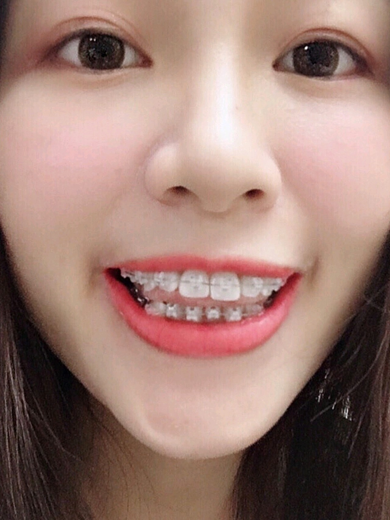 很暖和,不太豪华.我喜欢牙套价目表2020