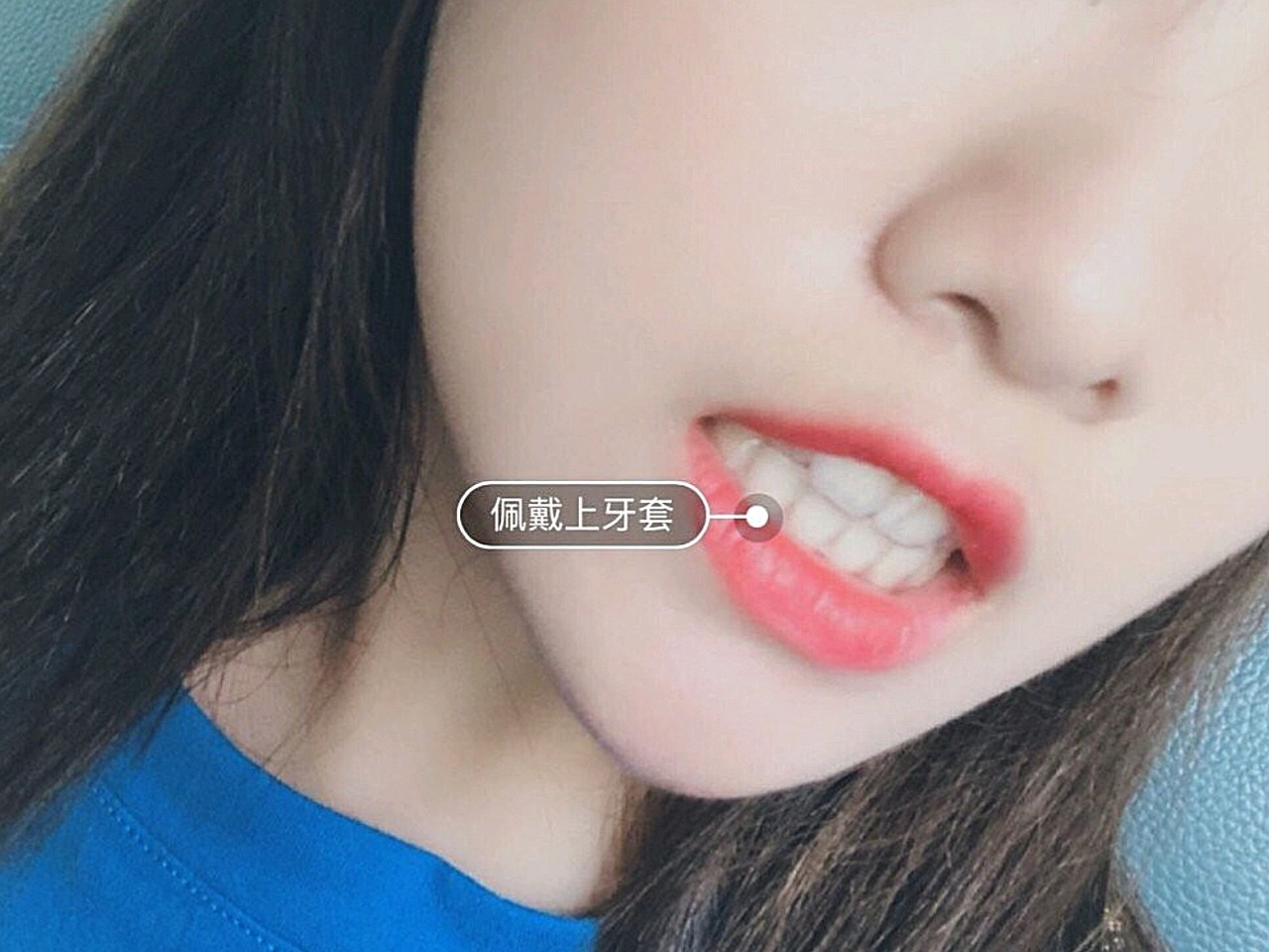 牙齿歪成扇形,上牙又折了出来,侧面很不舒服,为了美_圈子-新氧美容