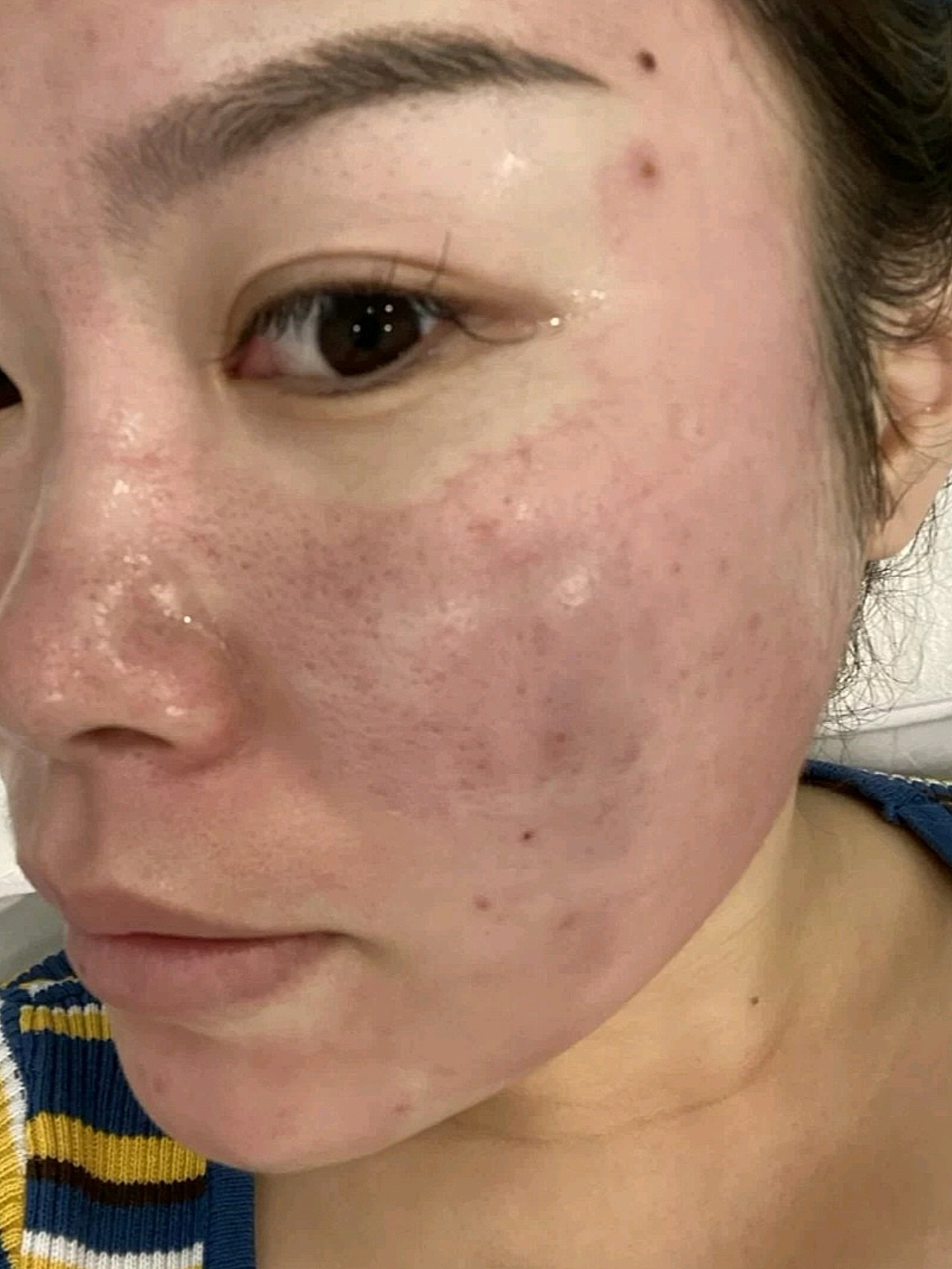 点阵激光第三天,脸上还是红的,这几天我脸都没碰水,_圈子-新氧美容