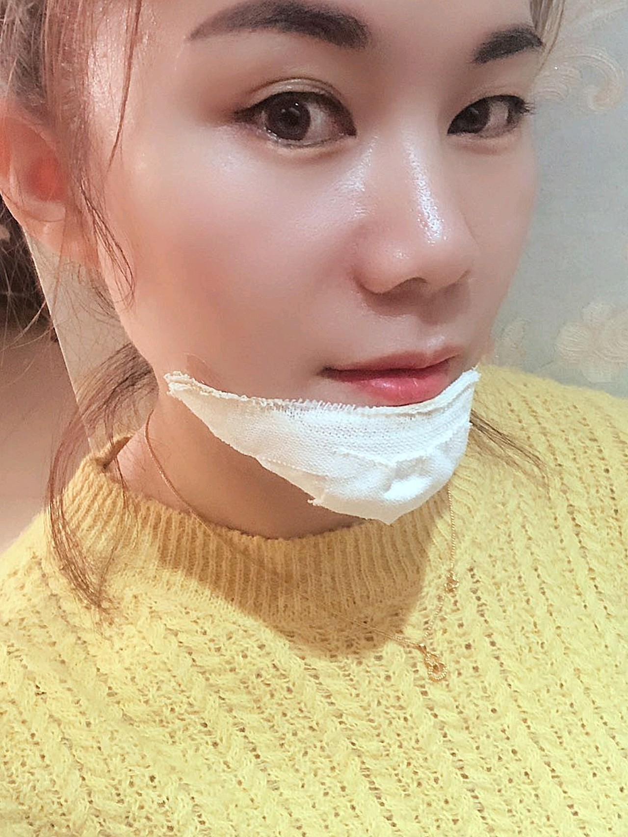 下巴是怎么了是不是,下巴是做了假体,所以现在包着纱布,过几天