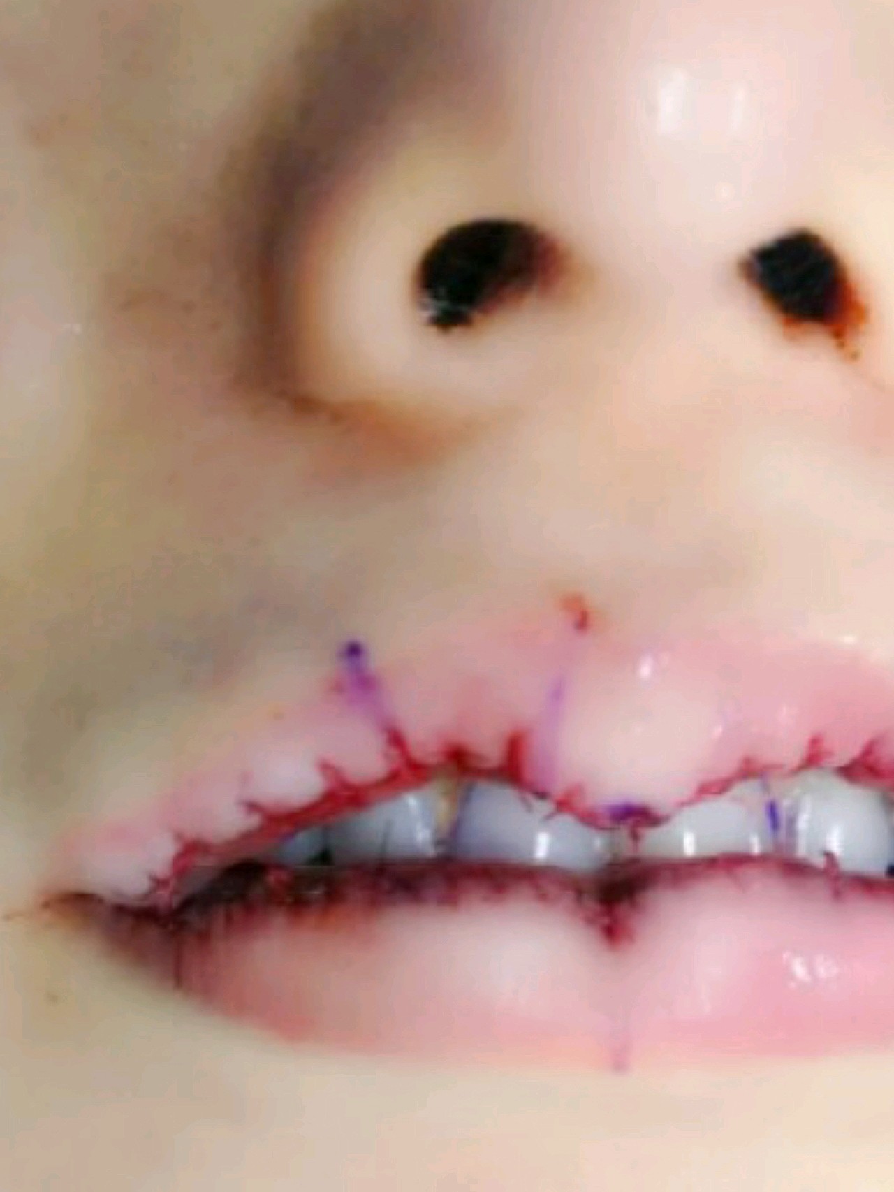 唇部样子不好看,做的是微笑唇